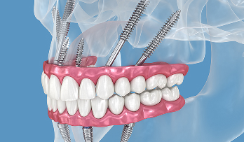 Zygomatic Implants